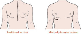 illustration of a traditional surgery incision which goes from the collarbone down past the sternum, and a minimally invasive incision which is much smaller